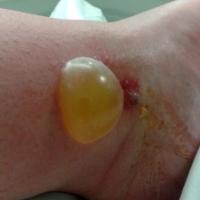 
	Bullae secondary to spider bite