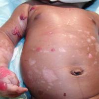 
	Epidermolysis bullosa