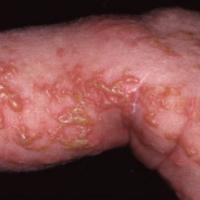 
	Incontinentia pigmenti

	Whorled pattern of…