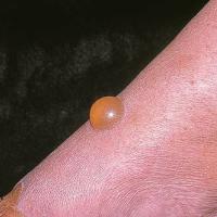 
	Papular urticaria