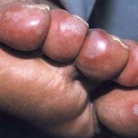 
	Perniosis