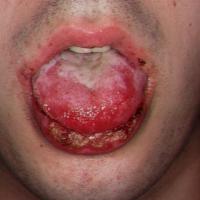 
	Stevens-Johnson syndrome
