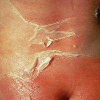 
	Staphylococcal Scalded Skin syndrome