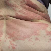 
	Pre-bullous pemphigoid

	Fixed urticated plaques
