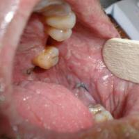 
	Bullous pemphigoid - oral involvement&nbsp;