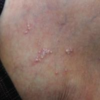 
	Milia post-pemphigoid
