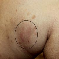 
	Calciphylaxis - early stage

	Tender,…