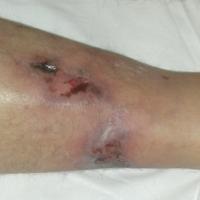 
	Calciphylaxis

	Livedoid changes and early…