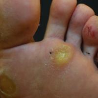 
	Callosities