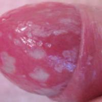 
	Balanitis - candida