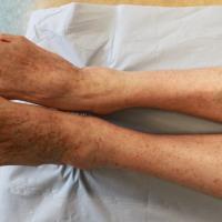 
	As previous image: post-treatment with…