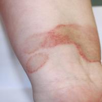 
	Majocchi's purpura&nbsp;of the wrist 