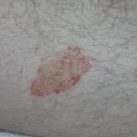 
	Same patient 

	Crops of brown-orange patches…
