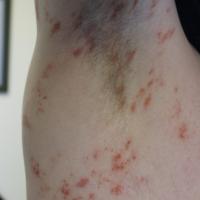 
	Pigmented purpuric dermatoses of the axilla -…