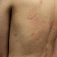 
	Majocchi's purpura - generalised