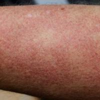 
	Poikiloderma

	Areas of telangiectasia, atrophy…