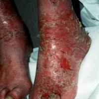 
	Contact allergic dermatitis to a combined…