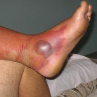 
	Cellulitis of the foot