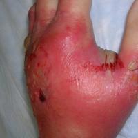 
	Cellulitis of the hand