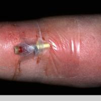 
	Cellulitis - iatrogenic