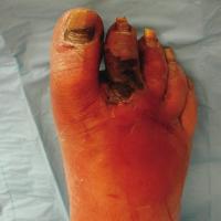 
	Cellulitis in a diabetic foot