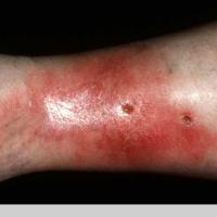 
	Cellulitis&nbsp;