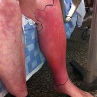 
	Cellulitis

	Marking the extent of cellulitis…