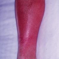 
	Cellulitis