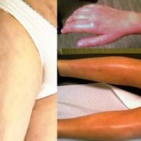 
	Eosinophilic fasciitis 