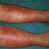 
	Gravitational eczema, not…