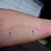 
	Lymphangitis