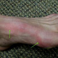 
	Lymphangitis