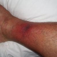 
	Early necrotising fasciitis

	Erythema and…