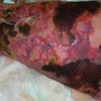 
	Necrotising fasciitis