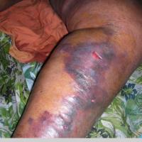 
	Necrotising fasciitis