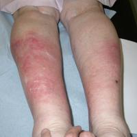
	Panniculitis

	&nbsp;
