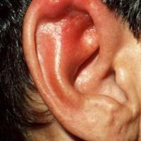 
	Cellulitis&nbsp;