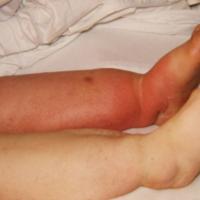 
	Cellulitis associated with lymphoedema