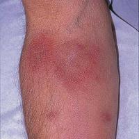 
	Eosinophilic cellulitis