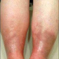 
	Sclerosing panniculitis (acute phase of…