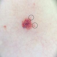 Angioma with a few vessels feeding in at the…