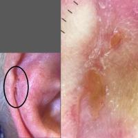 A basal cell carcinoma, not CDNH
The clue is in…