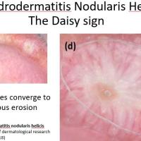 CDNH and the 'daisy sign'