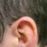 
	CDNH of helix with a small ulcer