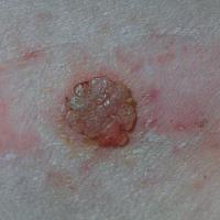 
	Clear cell acanthoma of Degos