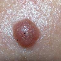 
	Clear cell acanthoma of Degos

	Vascular…