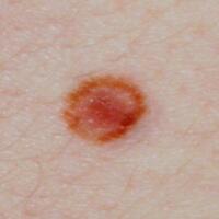 Cockade naevus (syn. Naevus en cocarde)
