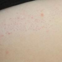 
	Same patient as previous image treated with a…
