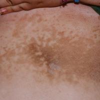 
	Confluent and reticulate papillomatosis