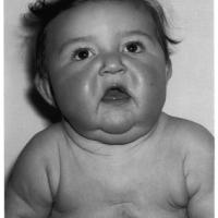 
	Cutis laxa
